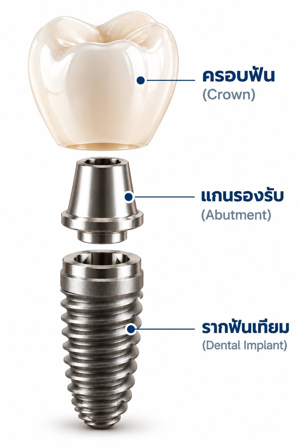 ส่วนประกอบของรากฟันเทียม: ครอบฟัน แกนรองรับ และรากฟันเทียม
